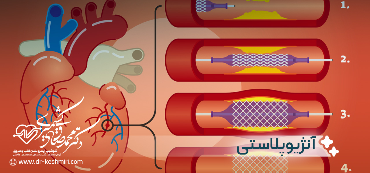 مراقبت های بعد از آنژیوپلاستی
