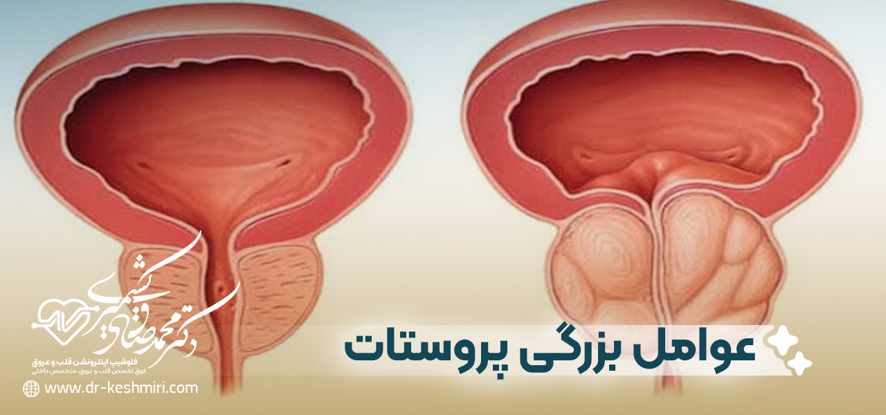 عواملی که ریسک ابتلا به بزرگی پروستات را افزایش می دهند