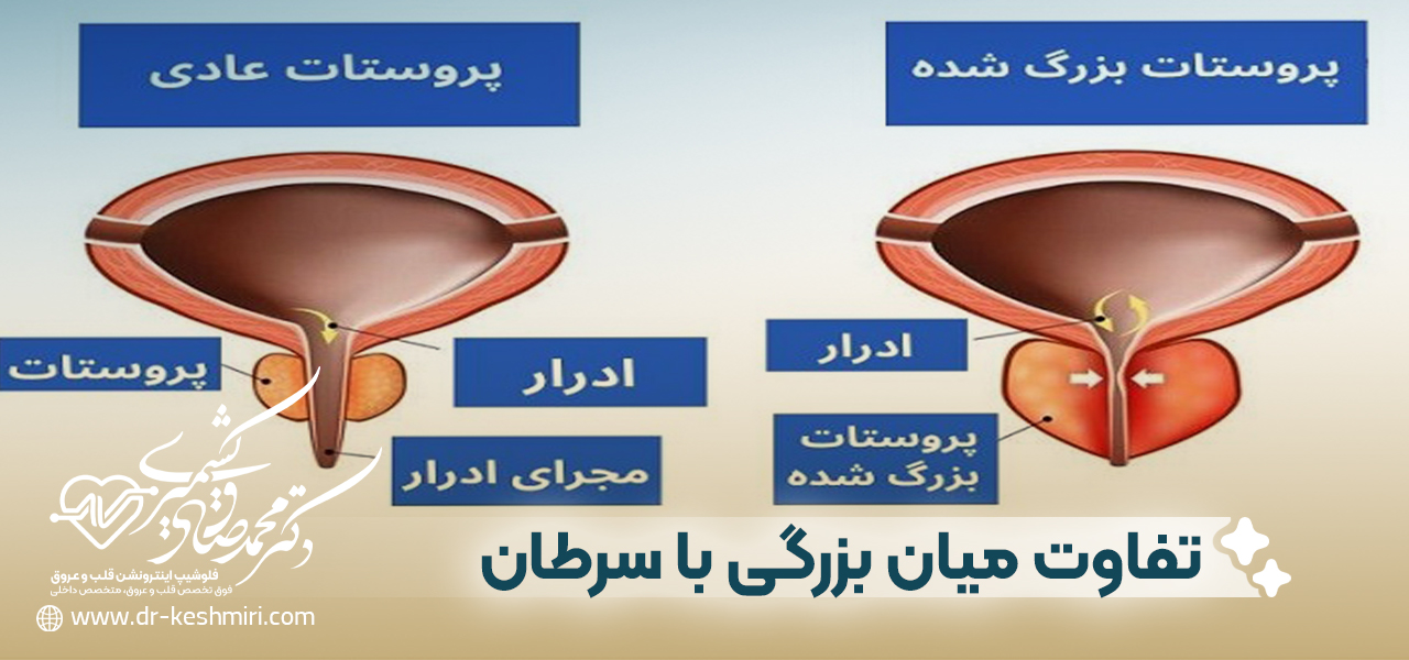 تفاوت میان بزرگی پروستات با سرطان پروستات
