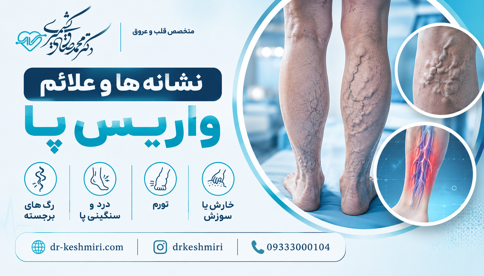 نشانه ها و علائم واریس پا