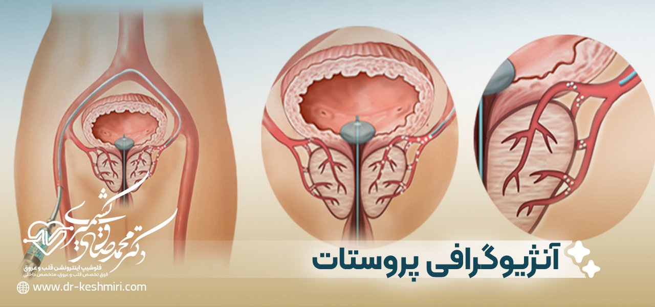 آنژیوگرافی پروستات چگونه است؟