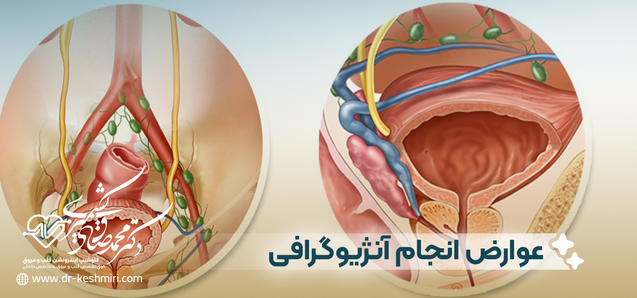 عوارض انجام آنژیوگرافی پروستات