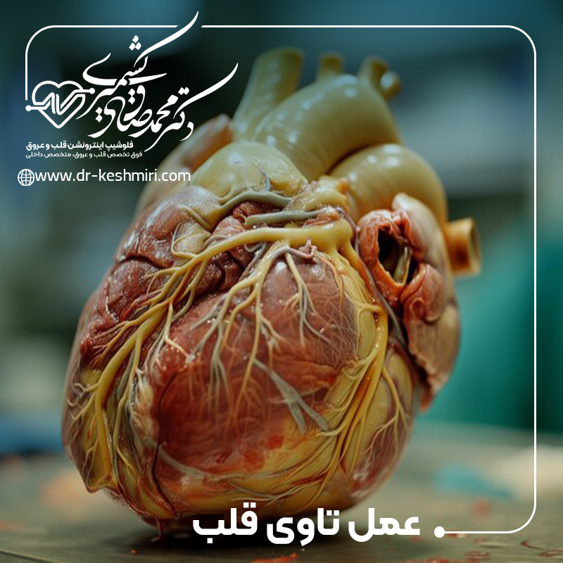 عمل تاوی TAVI چیست؟