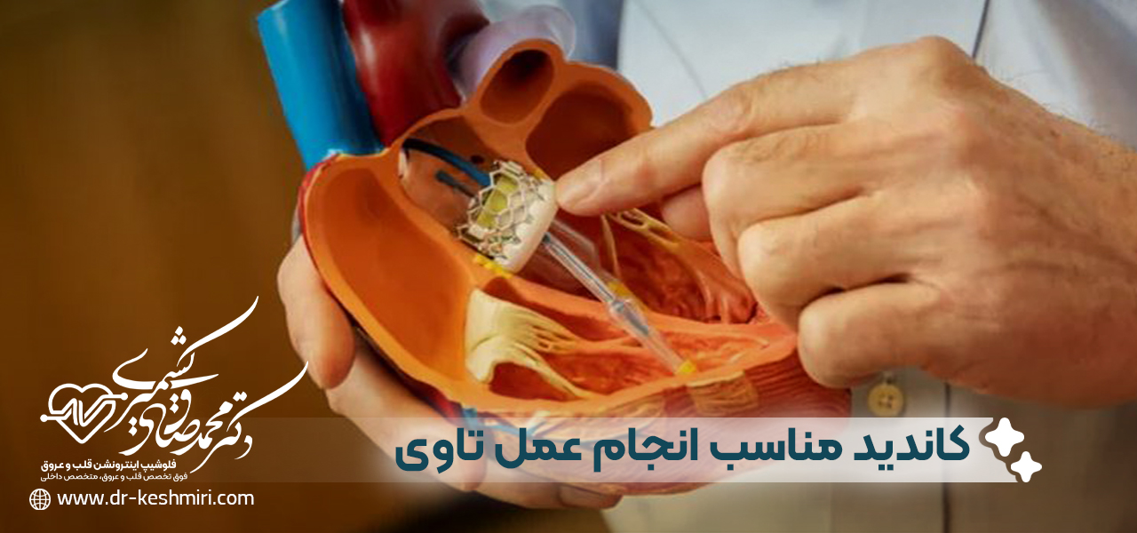 کاندید های مناسب انجام عمل تاوی