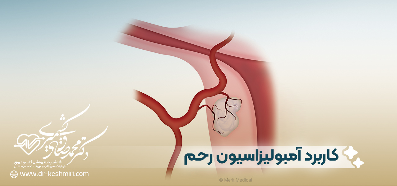 کاربرد آمبولیزاسیون رحم