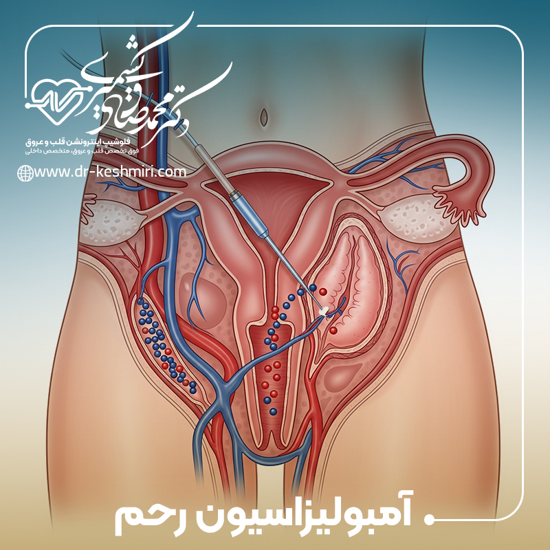 آمبولیزاسیون رحم