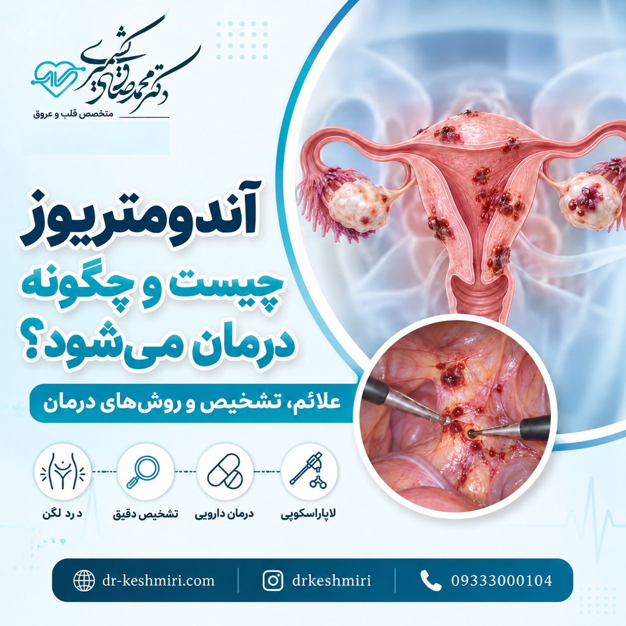 آندومتریوز چیست و چگونه درمان می شود؟