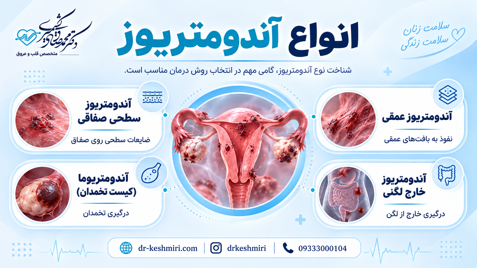 انواع آندومتریوز